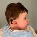 Koxlear İmplant istifadəçisini necə dəstəkləyə bilərsiniz?